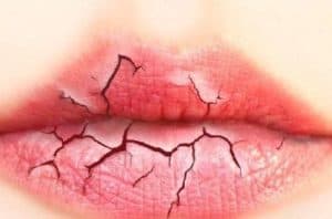 éviter les gerçures en utilisant un baume à lèvres naturel